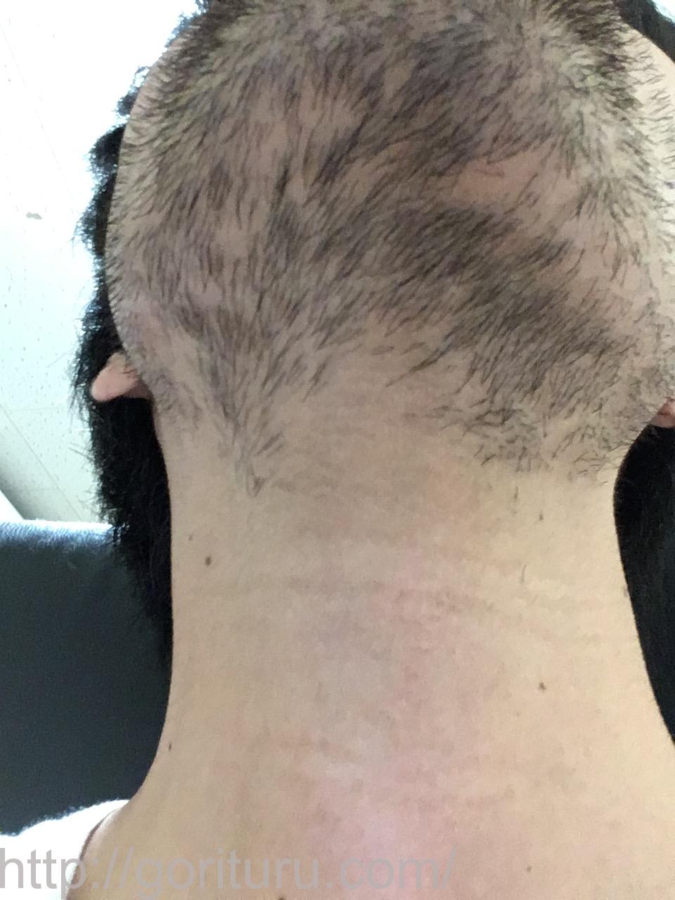 髭脱毛2回目 レーザー照射前 10日後 首 顎下 ヒゲ脱毛ジョリツル