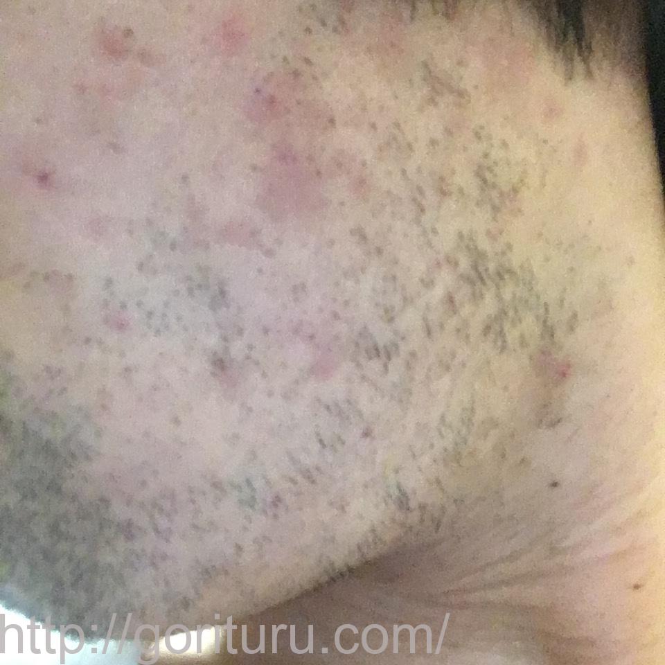 髭脱毛4回目の効果・経過写真（医療レーザー照射12日後｜左ほほ・もみあげ）