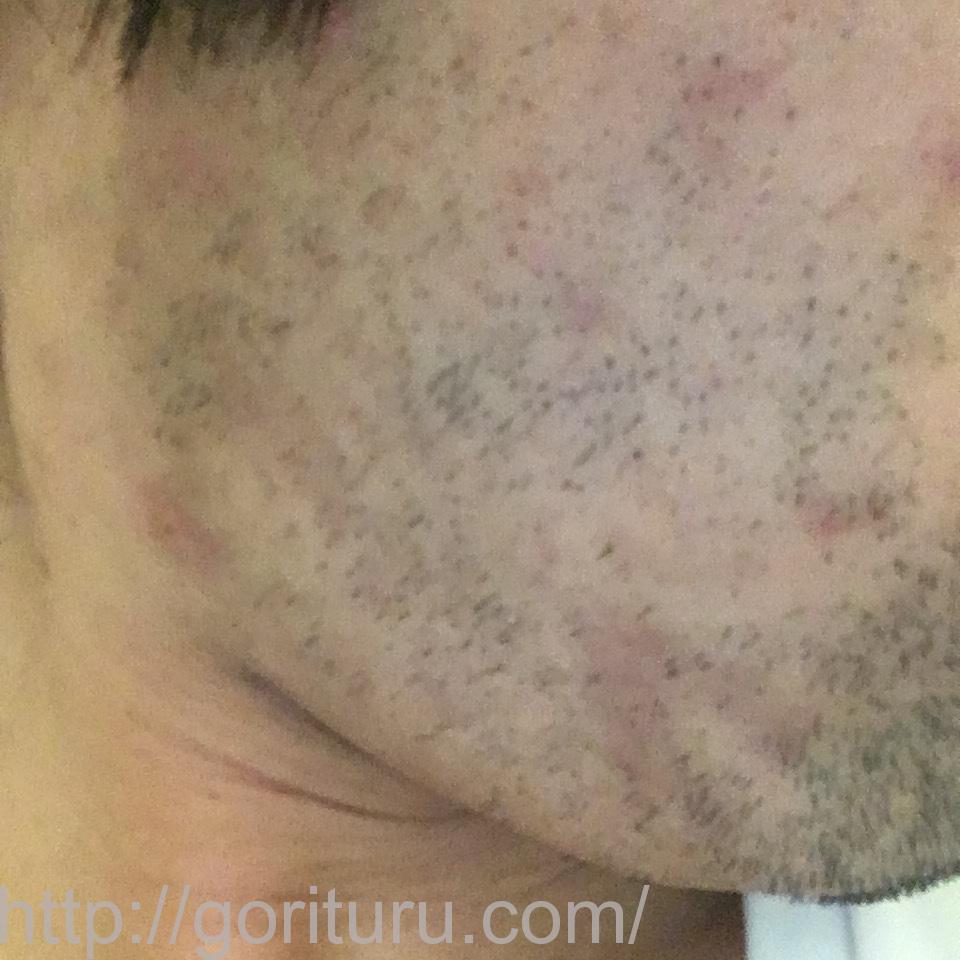 髭脱毛4回目の効果・経過写真（医療レーザー照射12日後｜右ほほ・もみあげ）