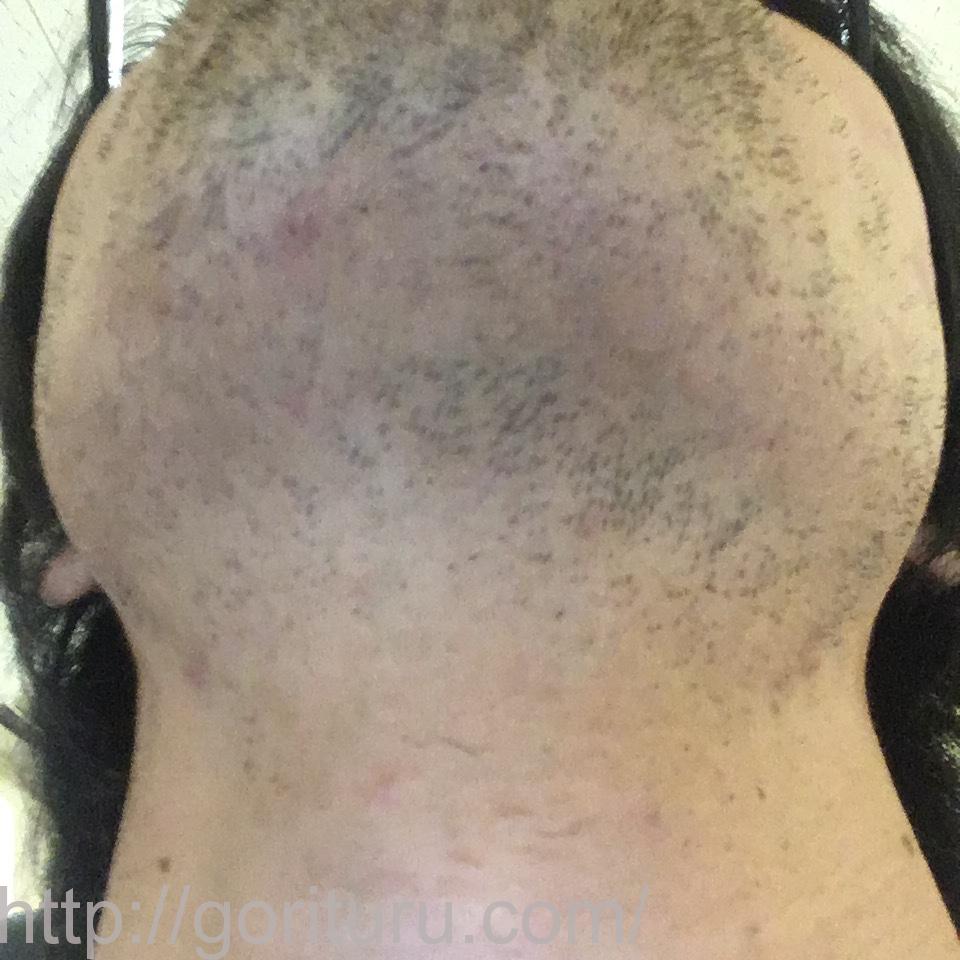 髭脱毛4回目の効果・経過写真（医療レーザー照射12日後｜首・アゴ下）