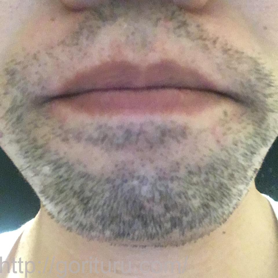 髭脱毛4回目の効果・経過写真（医療レーザー照射12日後｜鼻下・アゴ）