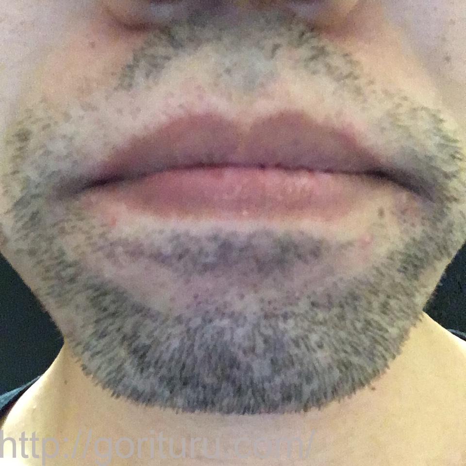 髭脱毛4回目の効果・経過写真（医療レーザー照射16日後｜鼻下・アゴ）