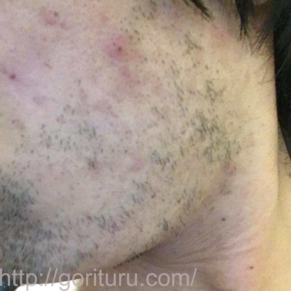 髭脱毛4回目の効果・経過写真（医療レーザー照射16日後｜左ほほ・もみあげ）