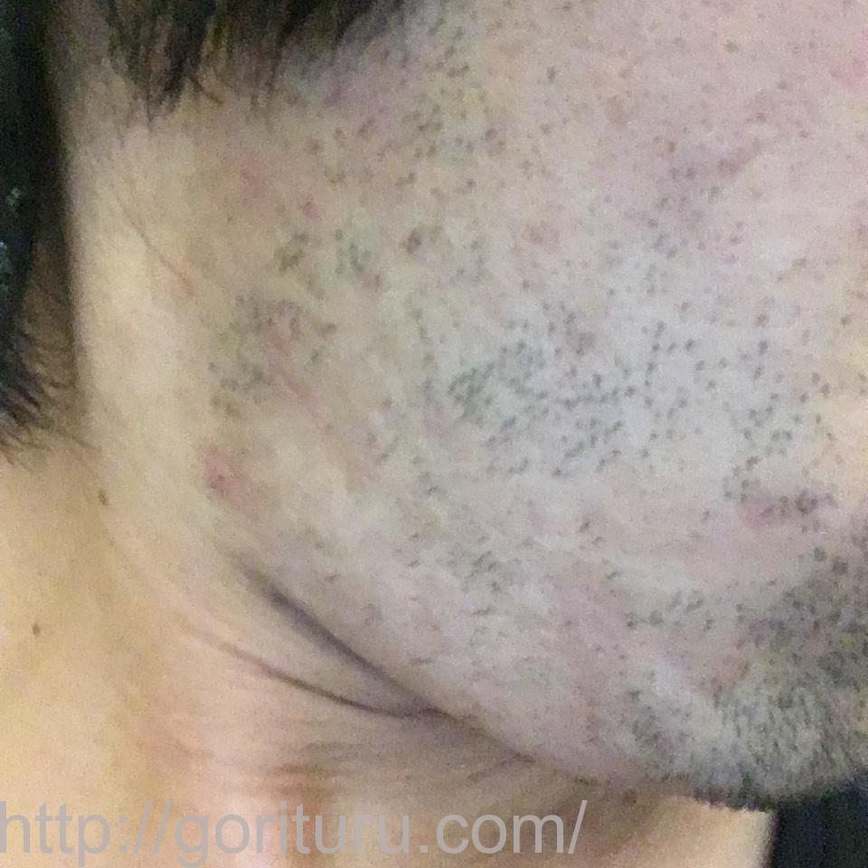 髭脱毛4回目の効果・経過写真（医療レーザー照射16日後｜右ほほ・もみあげ）