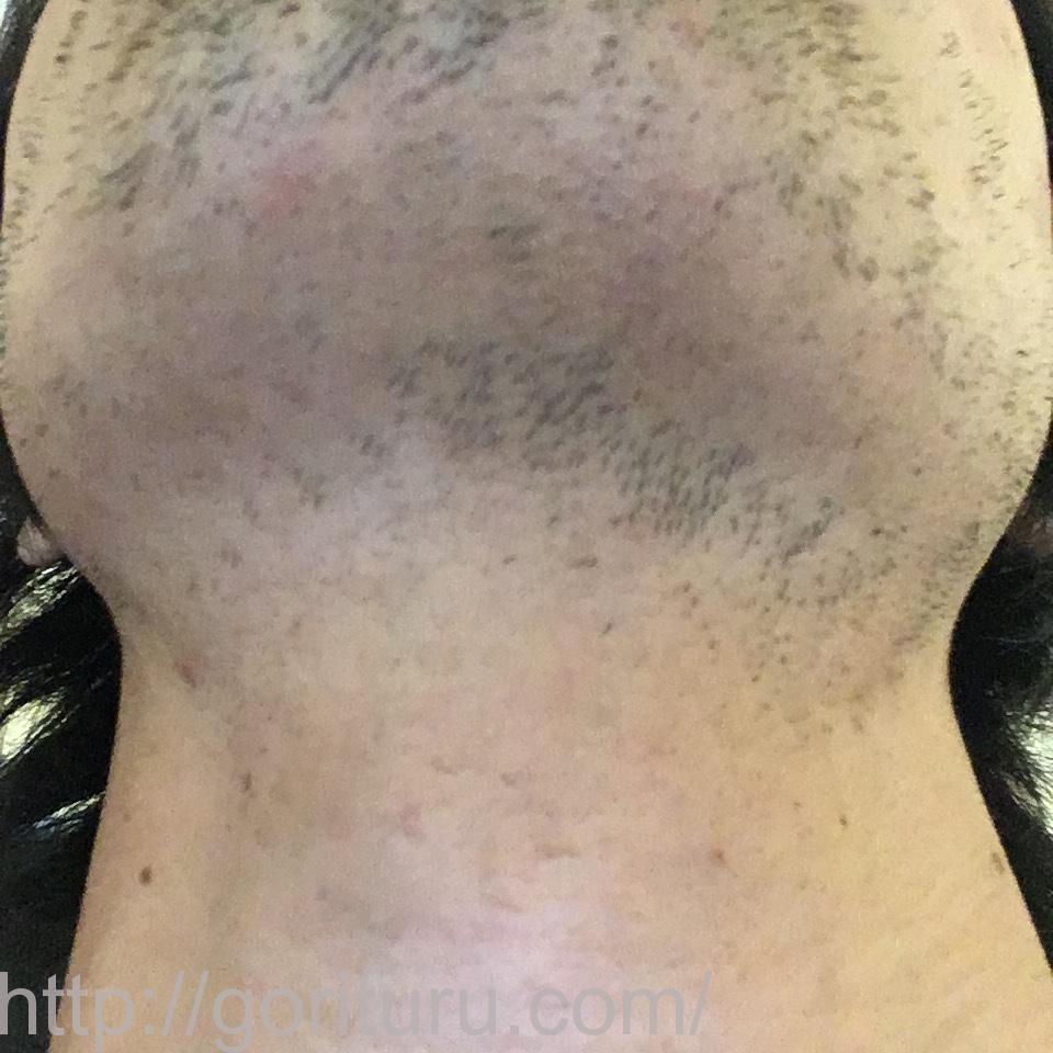 髭脱毛4回目の効果・経過写真（医療レーザー照射16日後｜首・アゴ下）