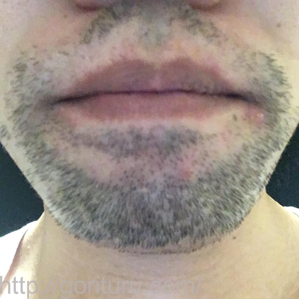 髭脱毛4回目の効果・経過写真（医療レーザー照射20日後｜鼻下・アゴ）