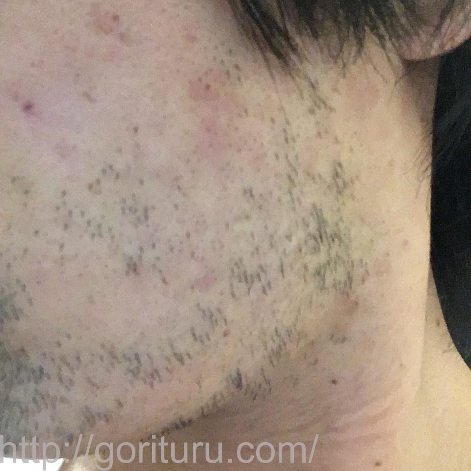 髭脱毛4回目の効果・経過写真（医療レーザー照射20日後｜左ほほ・もみあげ）