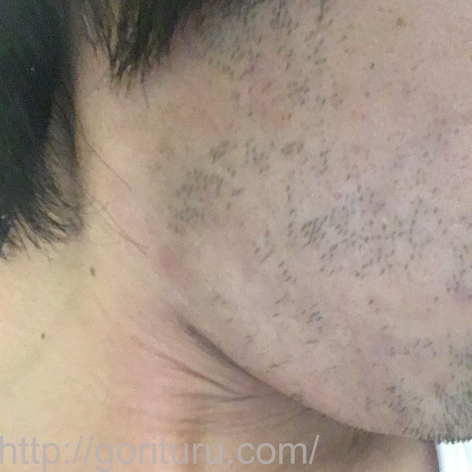 髭脱毛4回目の効果・経過写真（医療レーザー照射20日後｜右ほほ・もみあげ）