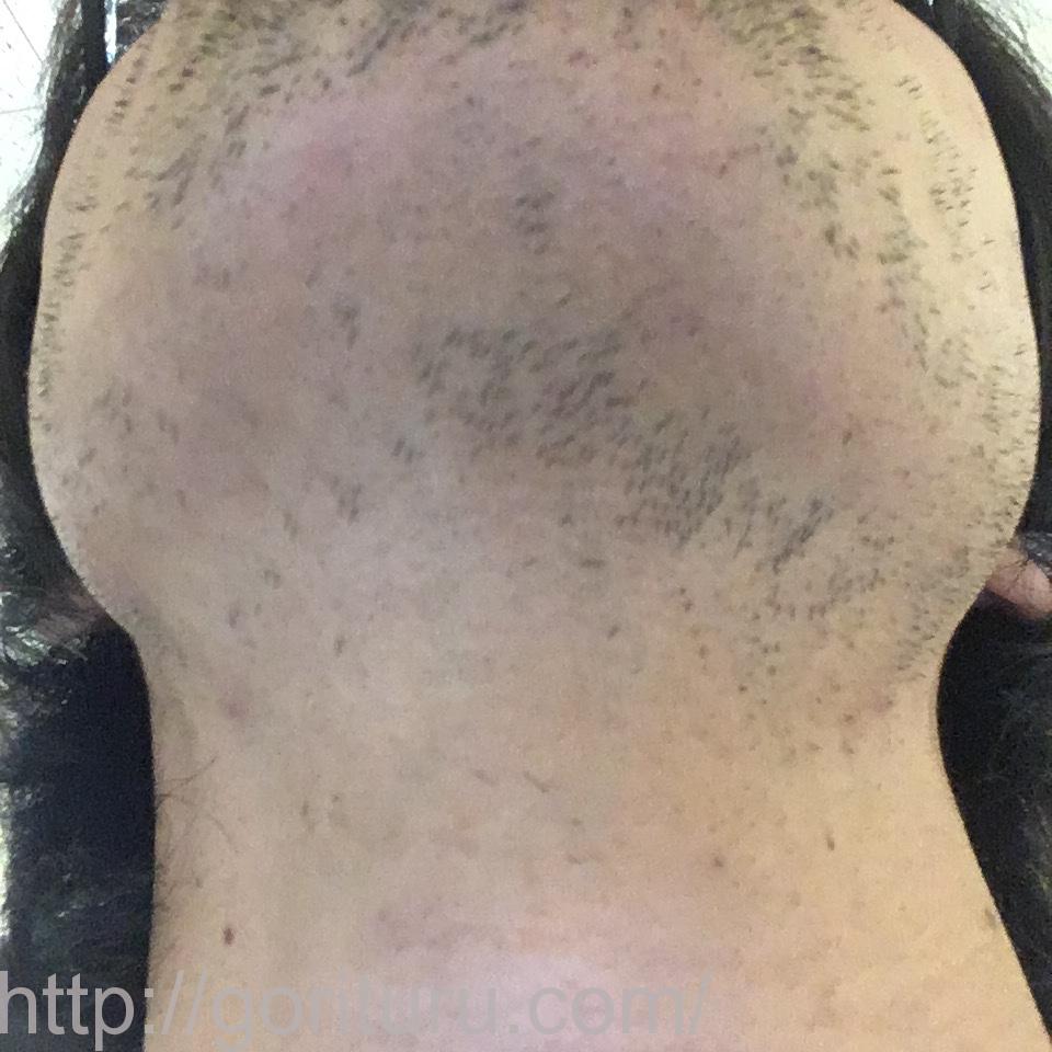 髭脱毛4回目の効果・経過写真（医療レーザー照射20日後｜鼻下・アゴ）