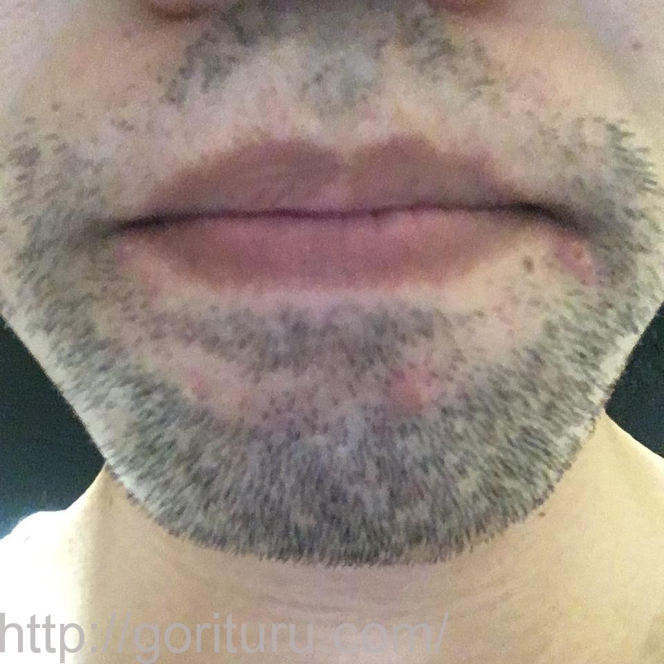 髭脱毛4回目の効果（医療レーザー照射24日後｜鼻下・アゴ）