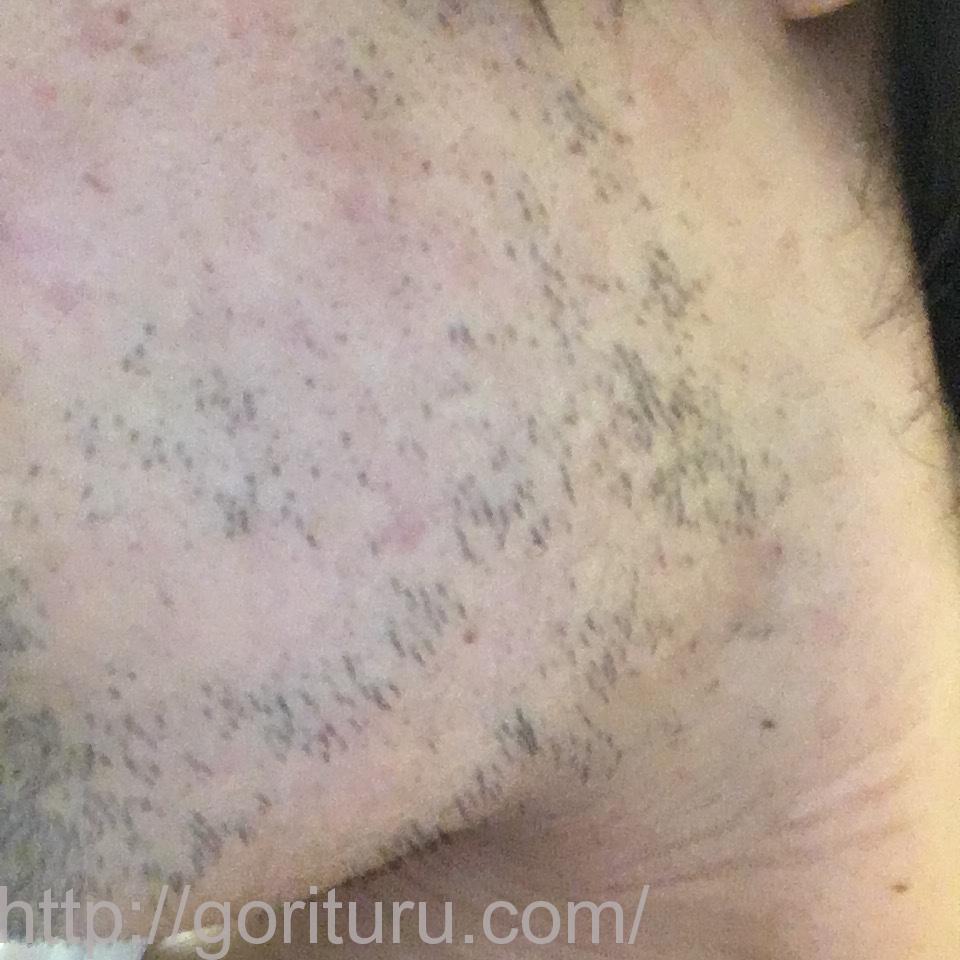 髭脱毛4回目の効果・経過写真（医療レーザー照射24日後｜左ほほ・もみあげ）