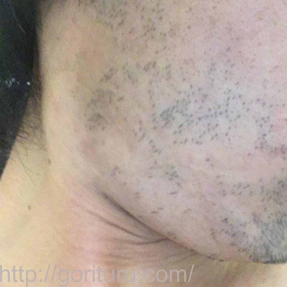 髭脱毛4回目の効果・経過写真（医療レーザー照射24日後｜右ほほ・もみあげ）