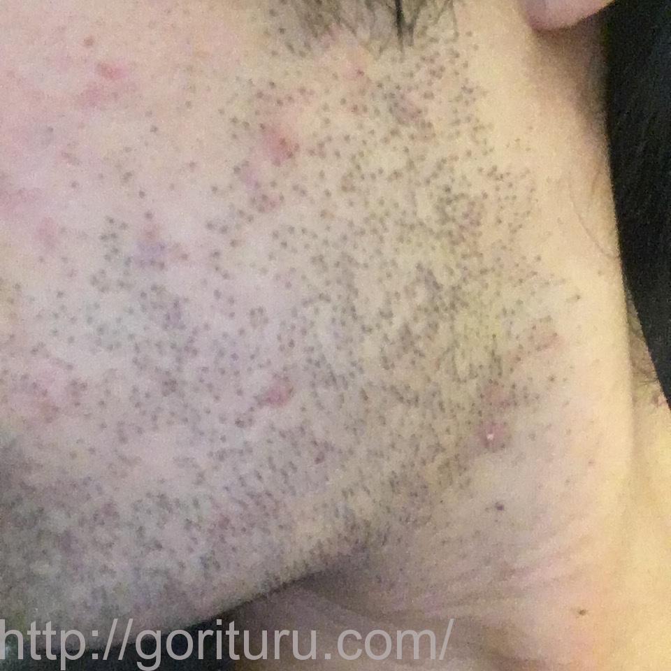 髭脱毛4回目の効果・経過写真（医療レーザー照射4日後｜左ほほ・もみあげ）