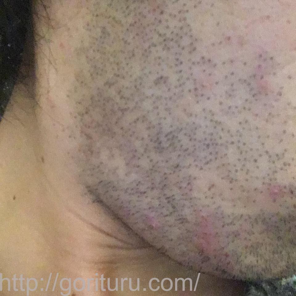 髭脱毛4回目の効果・経過写真（医療レーザー照射4日後｜右ほほ・もみあげ）