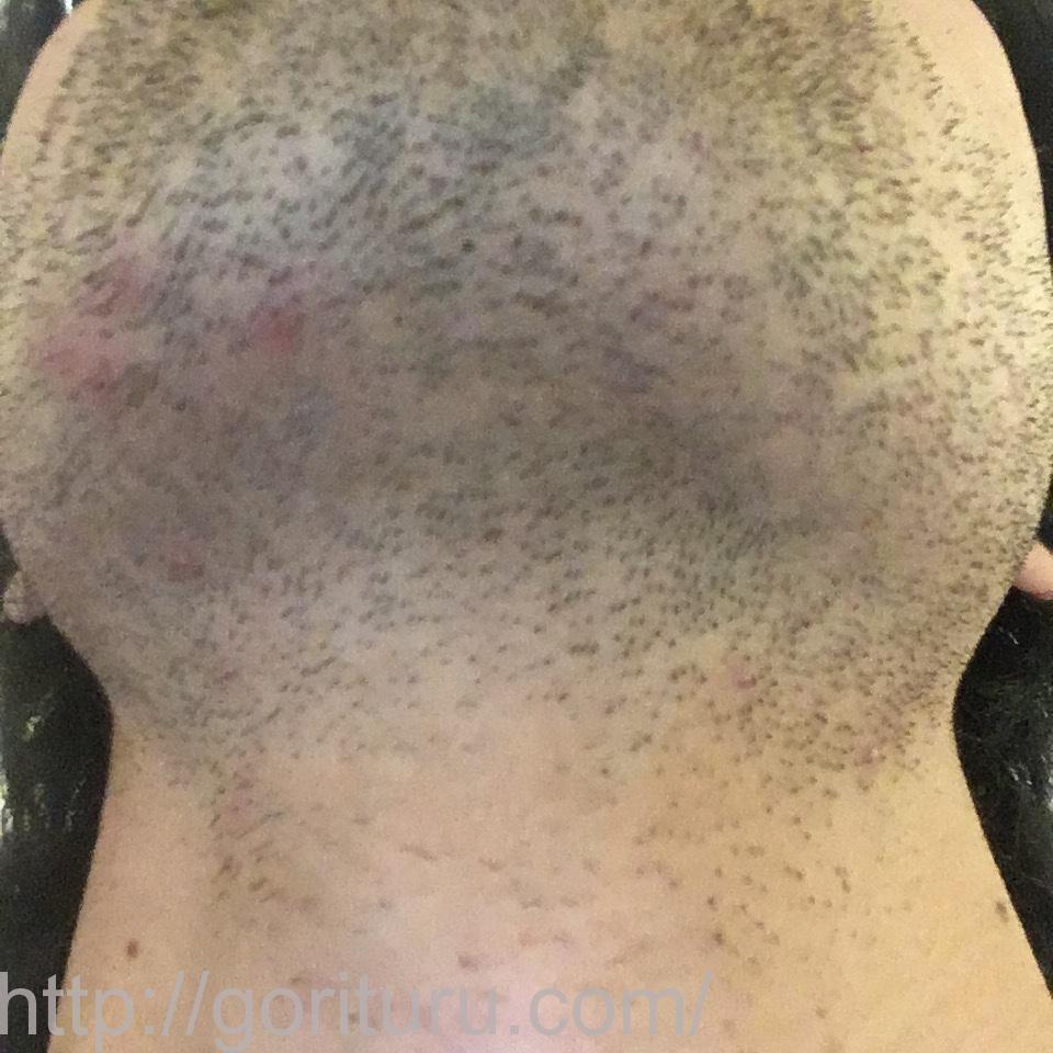 髭脱毛4回目の効果・経過写真（医療レーザー照射4日後｜首・アゴ下）