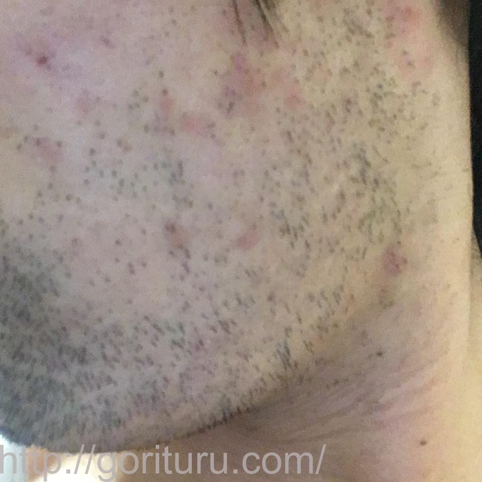 髭脱毛4回目の効果・経過写真（医療レーザー照射8日後｜左ほほ・もみあげ）