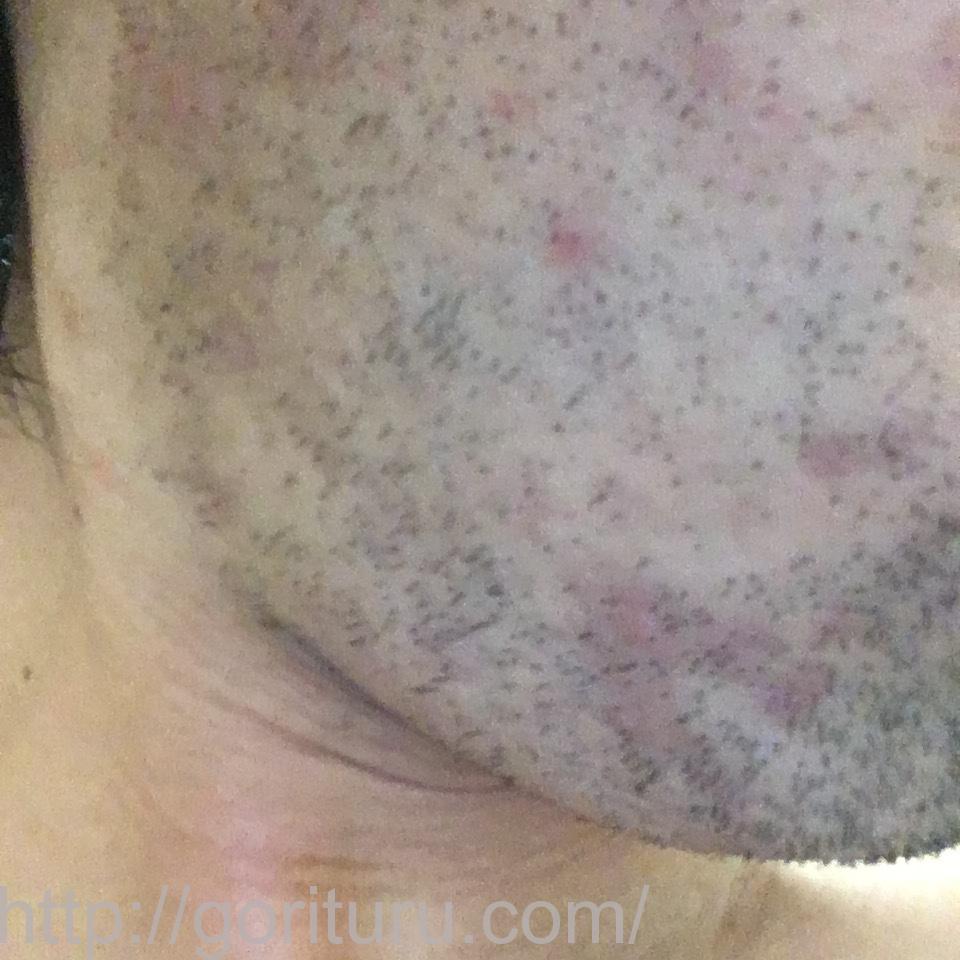 髭脱毛4回目の効果・経過写真（医療レーザー照射8日後｜右ほほ・もみあげ）