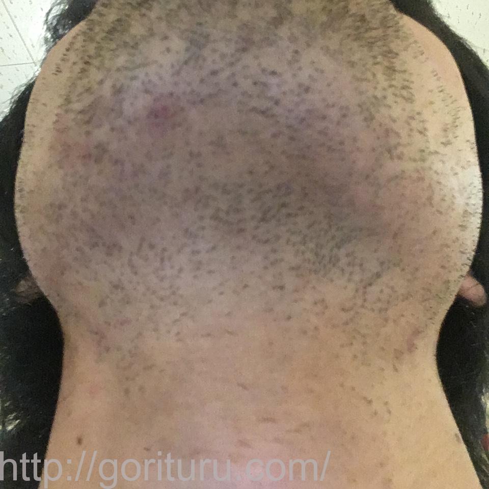 髭脱毛4回目の効果・経過写真（医療レーザー照射8日後｜首・アゴ下）