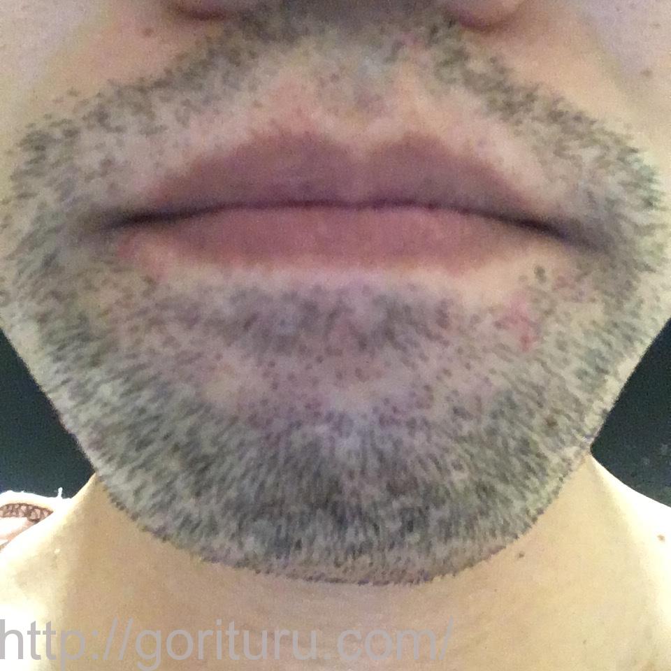 髭脱毛4回目の効果・経過写真（医療レーザー照射8日後｜鼻下・アゴ）