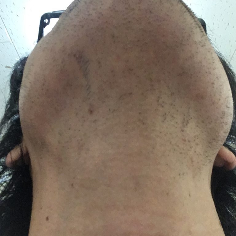 ヒゲ脱毛（医療レーザーの永久脱毛）5回目12日後の効果と変化（鼻下・首）