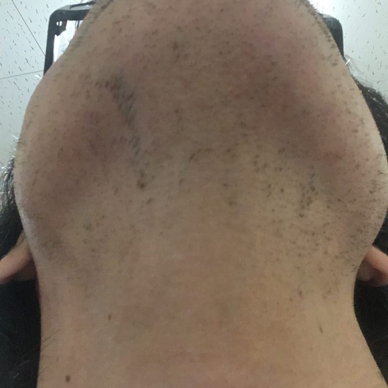 ヒゲ脱毛（医療レーザーの永久脱毛）5回目16日後の効果と変化（首・アゴ下）