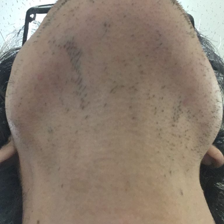 ヒゲ脱毛（医療レーザーの永久脱毛）5回目20日後の効果画像（鼻下・首）