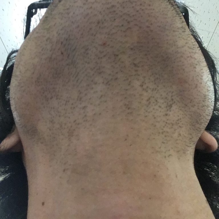 ヒゲ脱毛（永久脱毛）5回目8日後の効果と変化（首・アゴ下）