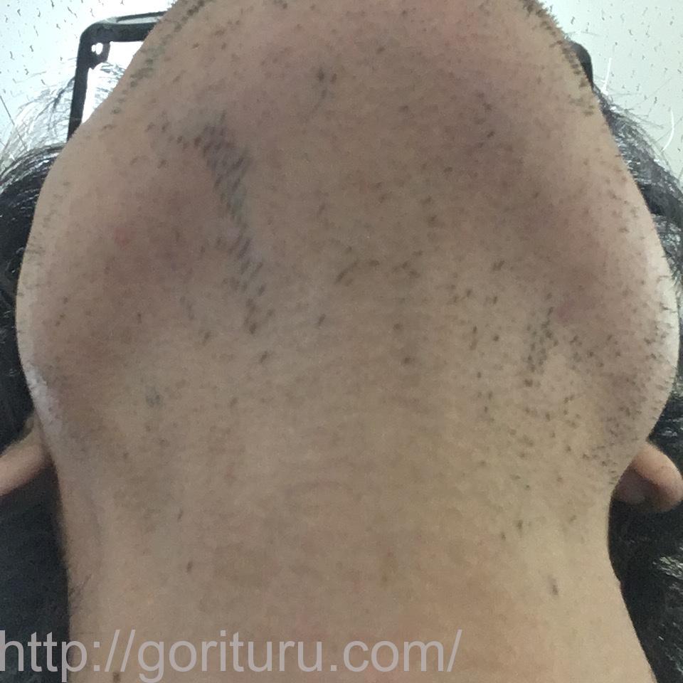 ヒゲ脱毛（医療レーザーの永久脱毛）5回目の効果画像（首・アゴ下）