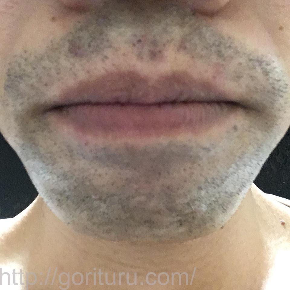 ヒゲ脱毛8回目のレーザー照射10日後（アゴ・鼻下）