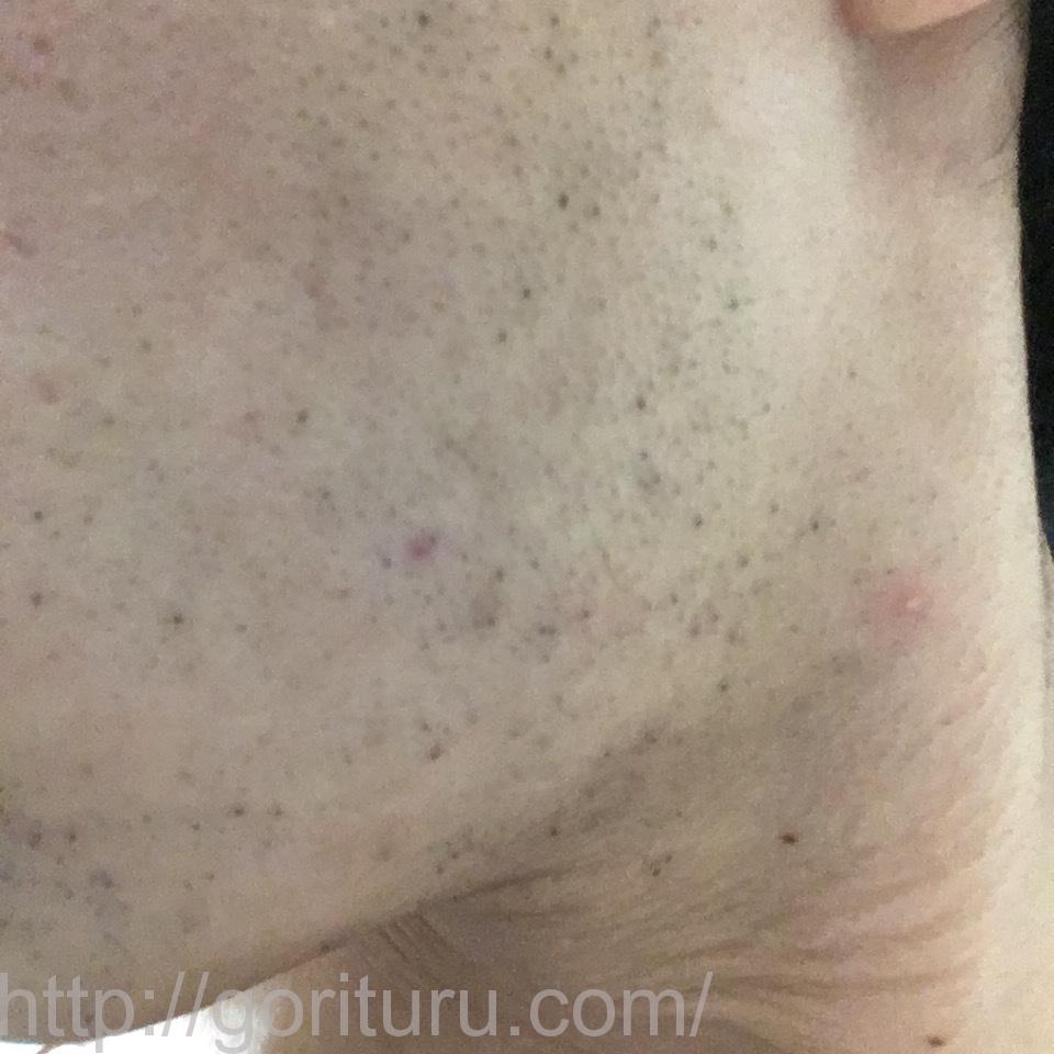 ヒゲ脱毛8回目のレーザー照射10日後（左ほほ・もみあげ）