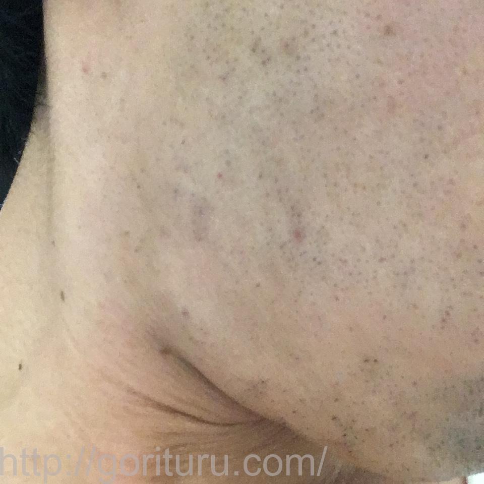 ヒゲ脱毛8回目のレーザー照射10日後（右ほほ・もみあげ）