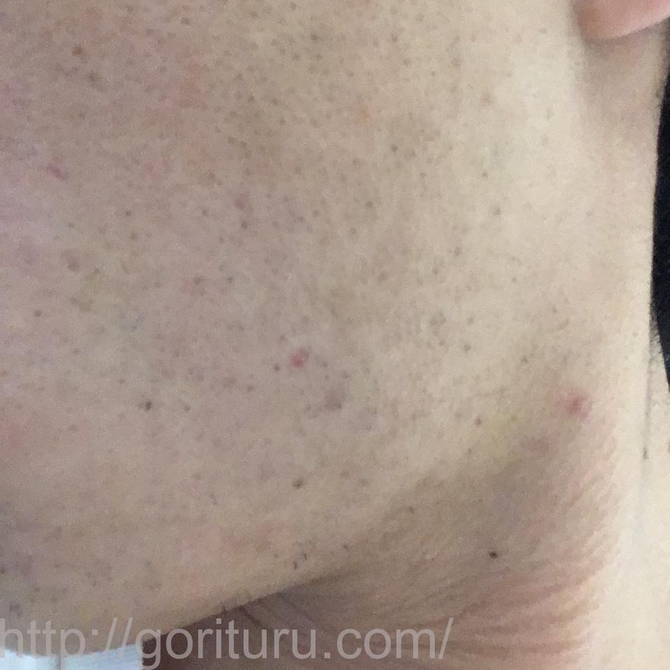 ヒゲのゴリラ脱毛効果@8回目（14日目・左ほほ・もみあげ）