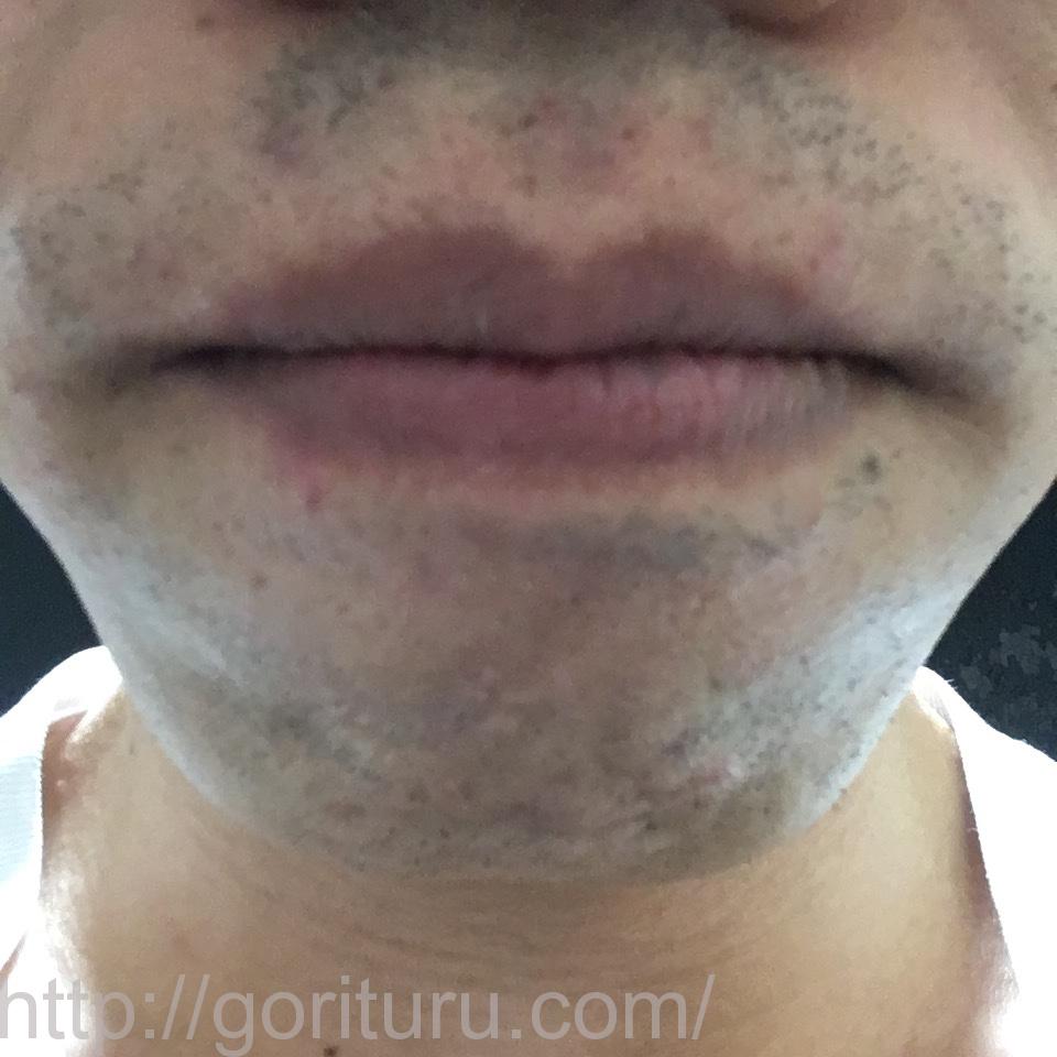 ヒゲのゴリラ脱毛効果@8回目（14日目・アゴ・鼻下）