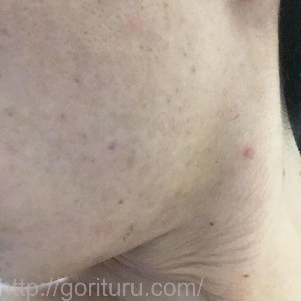 ヒゲ脱毛（レーザー脱毛）の驚異的な効果@8回目20日後（左ほほ・もみあげ）