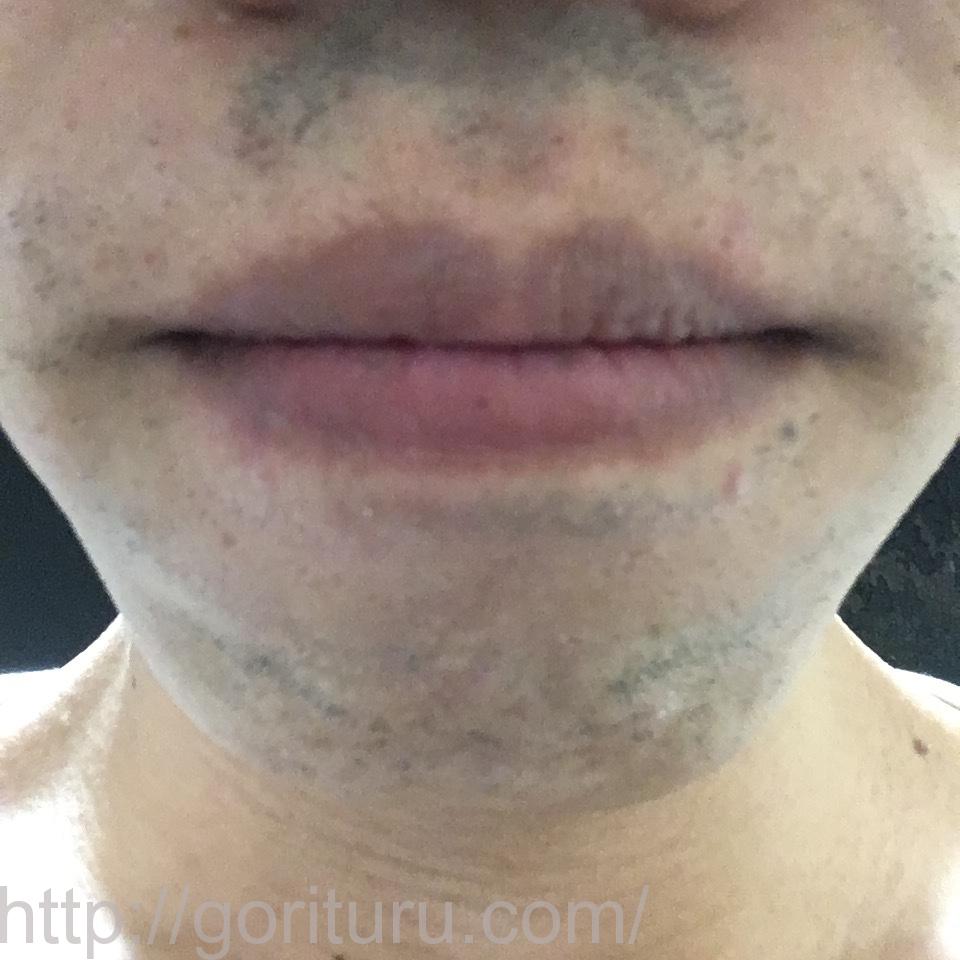 ヒゲ脱毛（レーザー脱毛）の驚異的な効果@8回目（アゴ・鼻下）