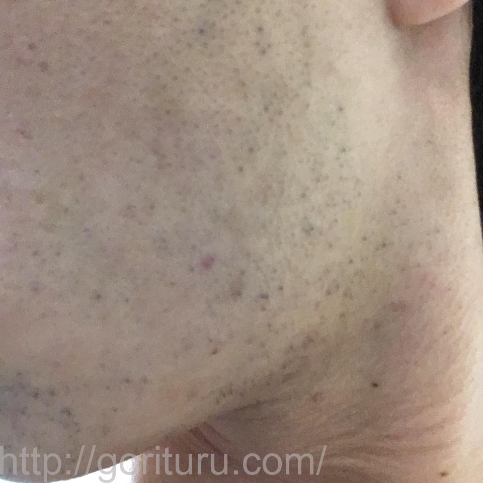 ゴリラクリニックで8回目のヒゲ脱毛を終えた後の効果（左ほほ・もみあげ@7日目）