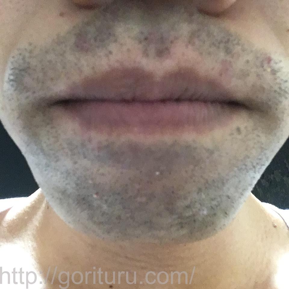 ゴリラクリニックで8回目のヒゲ脱毛を終えた後の効果（アゴ・鼻下@7日目）