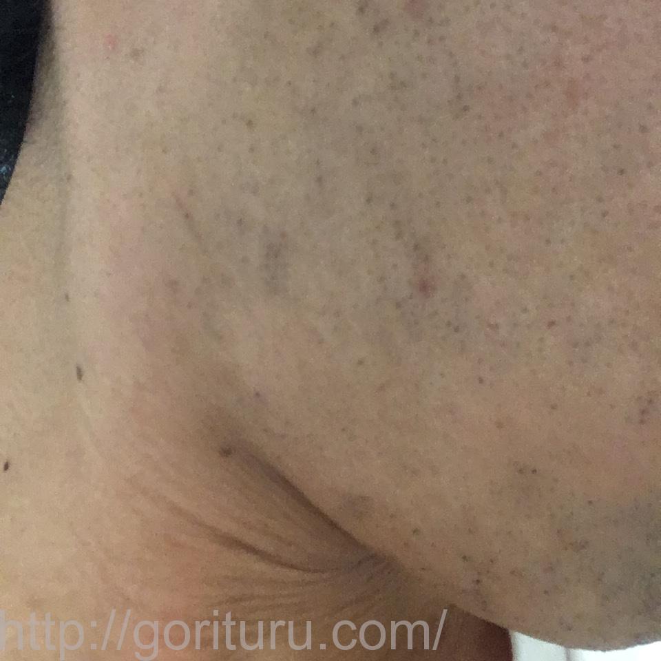 ゴリラクリニックで8回目のヒゲ脱毛を終えた後の効果（右ほほ・もみあげ@7日目）